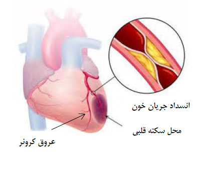 سکته قلبی