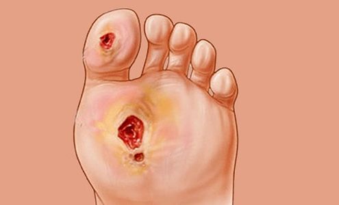 چه چیزی باعث می شود گانگرن به وجود آید؟