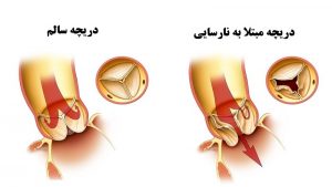 نارسایی دریچه آئورت