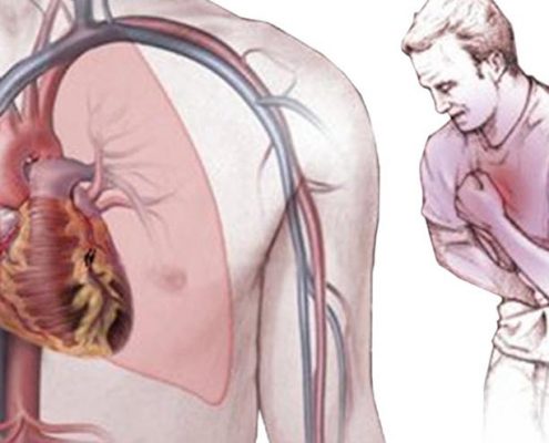 انواع آنژین صدری
