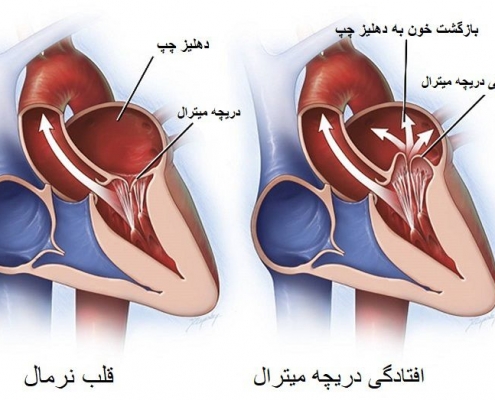آیا افتادگی دریچه قلب خطرناک است؟