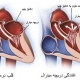 آیا افتادگی دریچه قلب خطرناک است؟