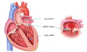 آیا افتادگی دریچه قلب خطرناک است؟