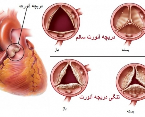 تعویض دریچه آئورت قلب