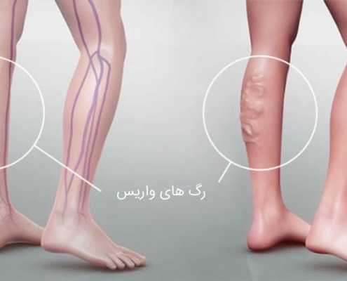 علائم واریس پا و راه های درمان آن چیست؟