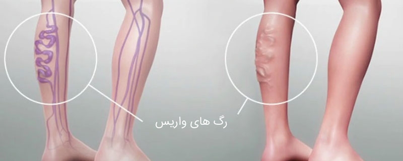 علائم واریس پا و راه های درمان آن چیست؟