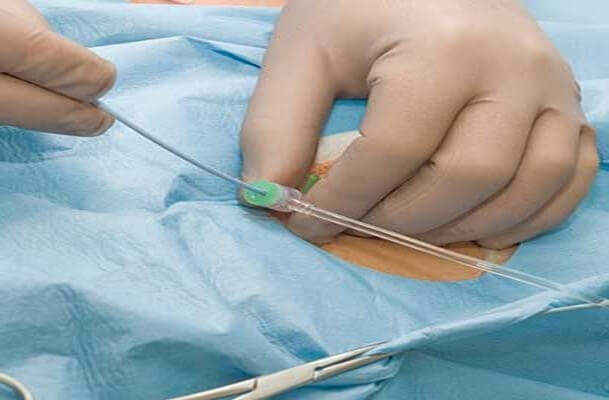 استفاده از آنژیوگرافی قلب-وب سایت دکتر جوزانی