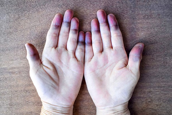 پیگیری بیماری سیانوز پیگیری بیماری سیانوز