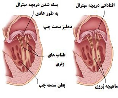 منظور از نارسایی دریچه میترال چیست ؟