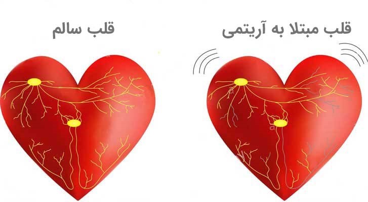علایم آریتمی قلبی علایم آریتمی قلبی