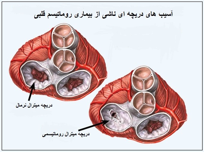 علایم بیماری روماتیسم قلبی علایم بیماری روماتیسم قلبی