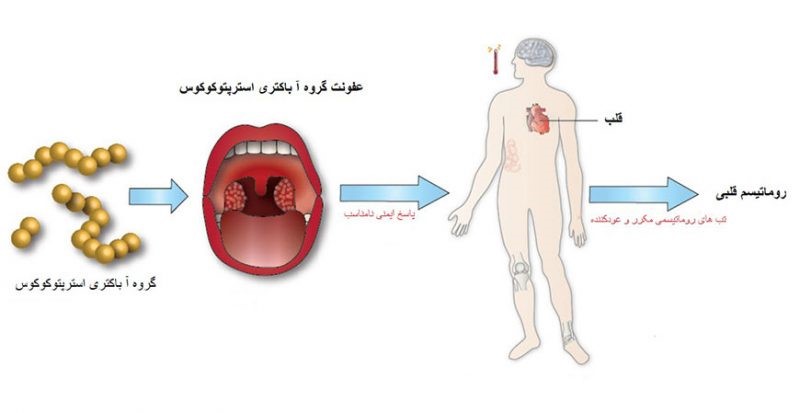 روشهای درمان بیماری روماتیسم قلبی روشهای درمان بیماری روماتیسم قلبی