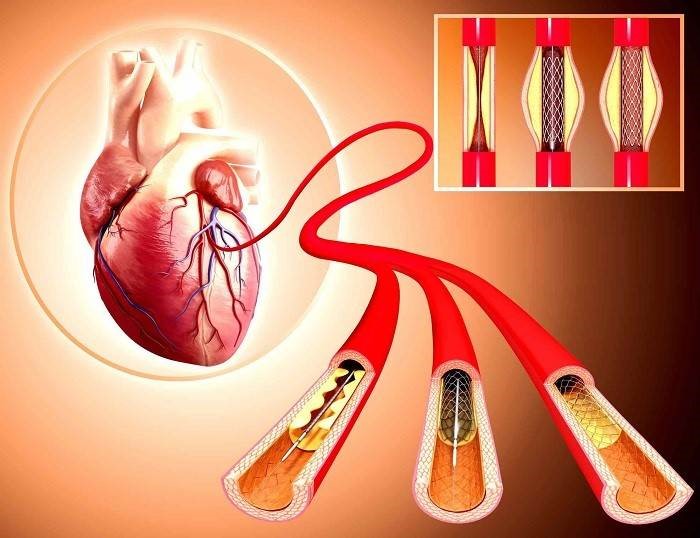 عوارض و خطرات ناشی از آنژیوگرافی قلب