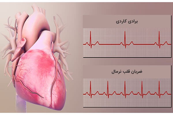 عوارض مربوط به آریتمی قلبی عوارض مربوط به آریتمی قلبی