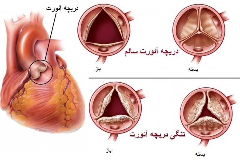 اختلال در دریچه های قلب: