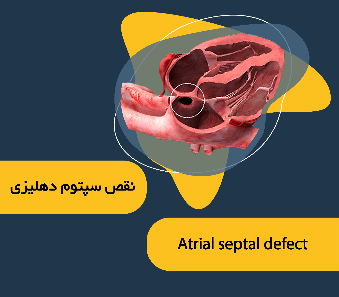 ترمیم نقص دیواره بین بطنی (VSD)