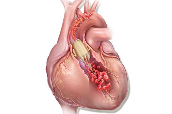 باز کردن دریچه‌ی میترال با بالون