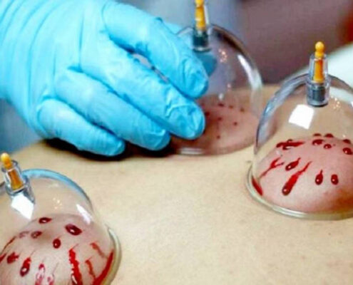 آیا حجامت برای تصفیه خون و قلب خوب است؟
